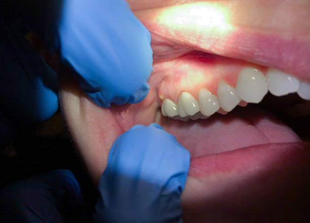 Best Emergency Gum Treatment in Pearl River, MS